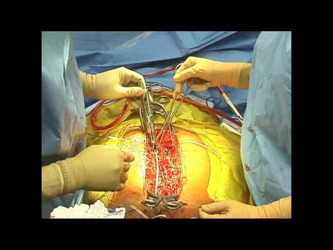 Anterior Discectomy & Posterior Spinal Instrumentation and Fusion (2 of 2) 