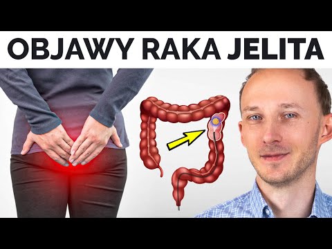 Takie są (wczesne?) objawy RAKA JELITA i co go powoduje