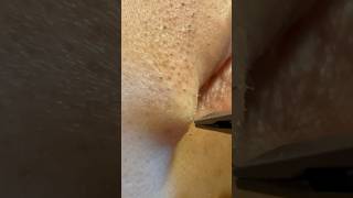 One Beard Hair, One Perfect Pull #hairremoval #tweezers #plucking #ingrownhair #satisfying