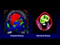 Detecting Prostate Cancer - YouTube