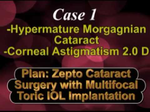 Zepto Cataract Surgery And Multifocal Toric IOL in Hypermature Morgagnian Cataract