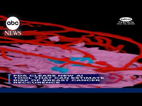 FDA clears new AI tool that can estimate risk of breast cancer recurrence