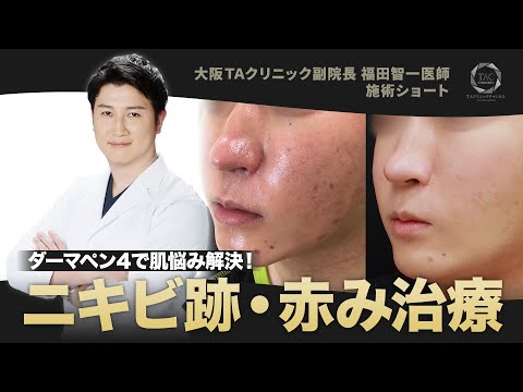 ダーマペンで肌治療!ニキビ跡・赤みが劇的解消?