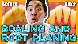 Scaling and Root Planing Do You Really Need It?