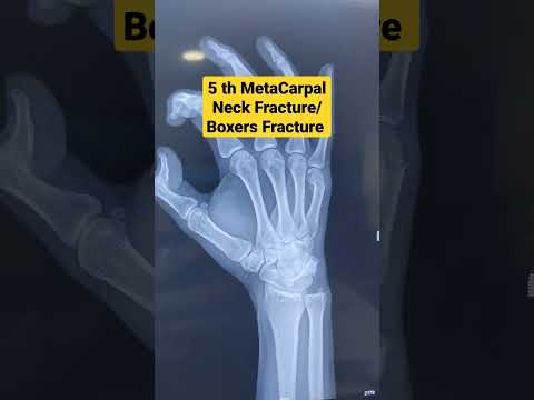 5 th MetaCarpal Neck Fracture / Boxers Fracture ...Dr Sai Chandra..Knee N Shoulder Surgeon