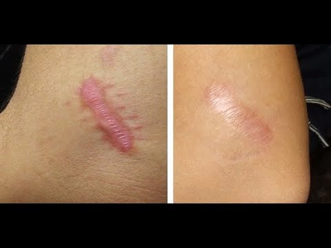 Das Beruhigungsmittel bei der Schuppenflechte Die Salben von der Schuppenflechte in kasachstane