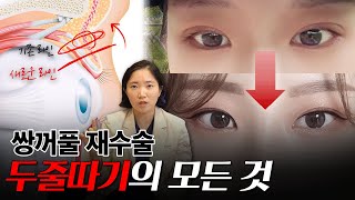 쌍꺼풀 재수술 두줄따기2️⃣제대로 하면 인상까지 달라집니다! | 재수술 노하우 공개✨
