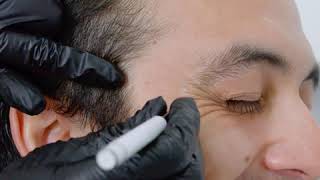 Botox en Patas de Gallo