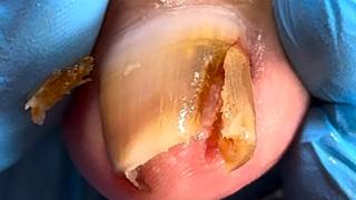 His Toenails Had Two Hooks, Very Sharp, Which He Dug Out【Xue Yidao】