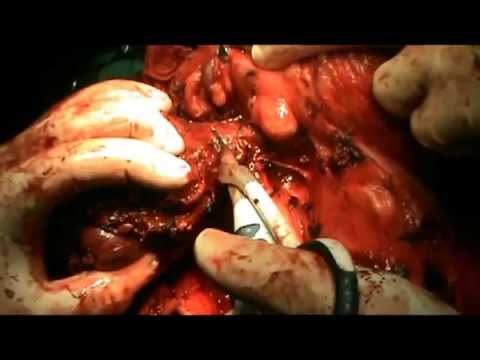 Radical Neck Dissection Right Side For MUO