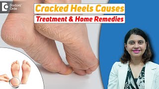 10 Home Remedies for CRACKED HEELS | Magical Cracked Heel Remedies-Dr. Amee Daxini | Doctors