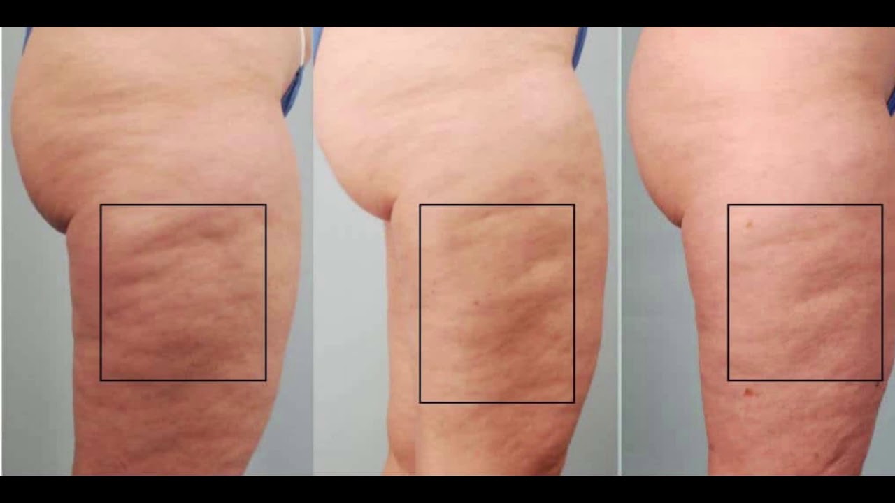 Watch Now CARBOSSITERAPIA per cellulite, flaccidita' e adiposita' localizzate CARBOSSITERAPIA per cellulite, flaccidita' e adiposita' localizzate
