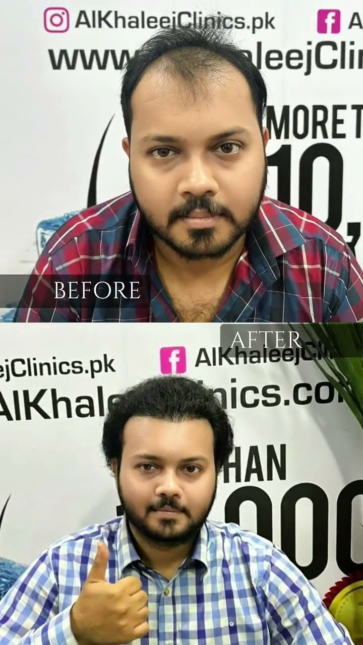 Best hair transplant in Karachi - AlKhaleej Clinics short