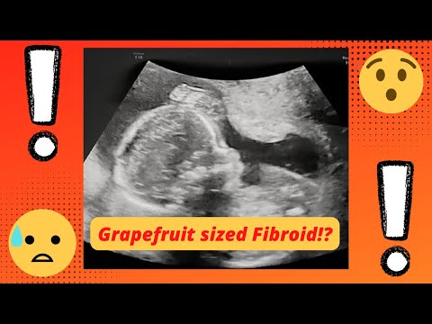 Getting diagnosed with GRAPEFRUIT SIZED FIBROID WHILE PREGNANT! PART 1