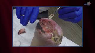 WCW: Removing Necrotic Tissue to Promote Healing