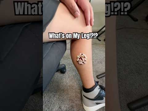 I think I got the Bubonic Plague?!?