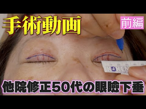 医学科 【前編】50代の眼瞼下垂デザイン解説ほぼノーカット手術動画│デザイン解説