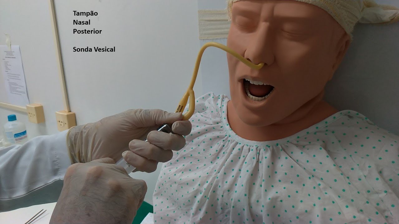 Tampão nasal posterior  - Sonda Vesical