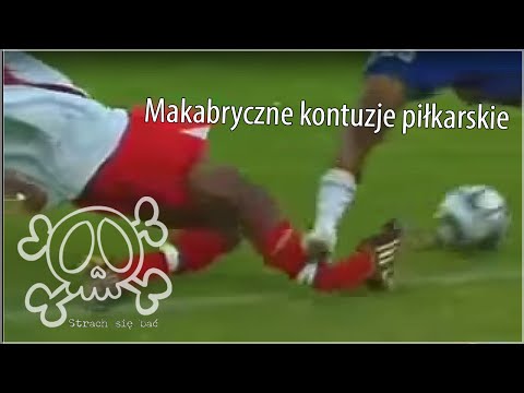 Wpadać na śródstopie Koślawe zniekształcenie obrazu stóp