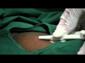 Contraceptive Implants 11 Procedure Insert Implant
