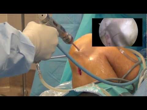 Arthroscopic ACL Reconstruction 