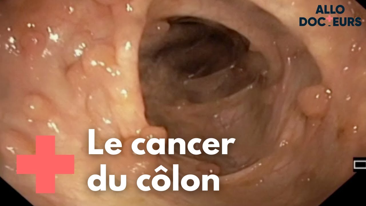 Cancer colorectal : quelle prise en charge ? - Allo Docteurs