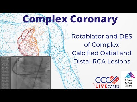 Rotablator and DES of Complex Calcified Ostial and Distal RCA Lesions - Dec 20, 2011 Webcast Video