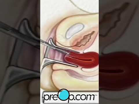Dilation and Curettage D & C Surgery | PreOp® Patient Engagement and Education #shorts