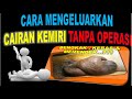 BERIKUT MENGHILANGKAN BEKAS SUNTIK SILIKON MINYAK KEMIRI AMAN TANPA HARUS OPERASI