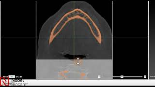 Fully Edentulous CBCTs Import