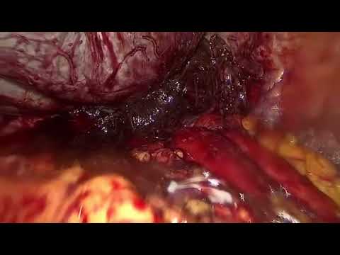 Laparoscopic Splenectomy – Part 2
