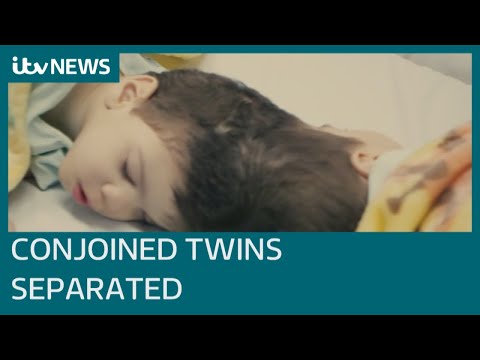 Conjoined twins with fused brains successfully separated with help of British surgeon | ITV News