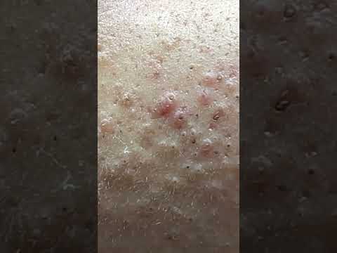 Let's Count Acnes - ACNE TREATMENT MAI NGOC FAMILY 💕💕 - ACNE TREATMENT MAI NGỌC - demo