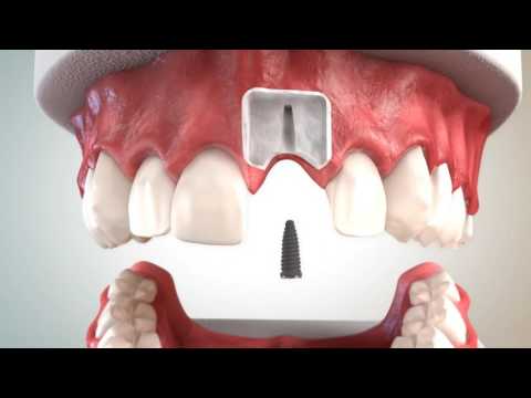 Replacing a missing tooth using a dental implant