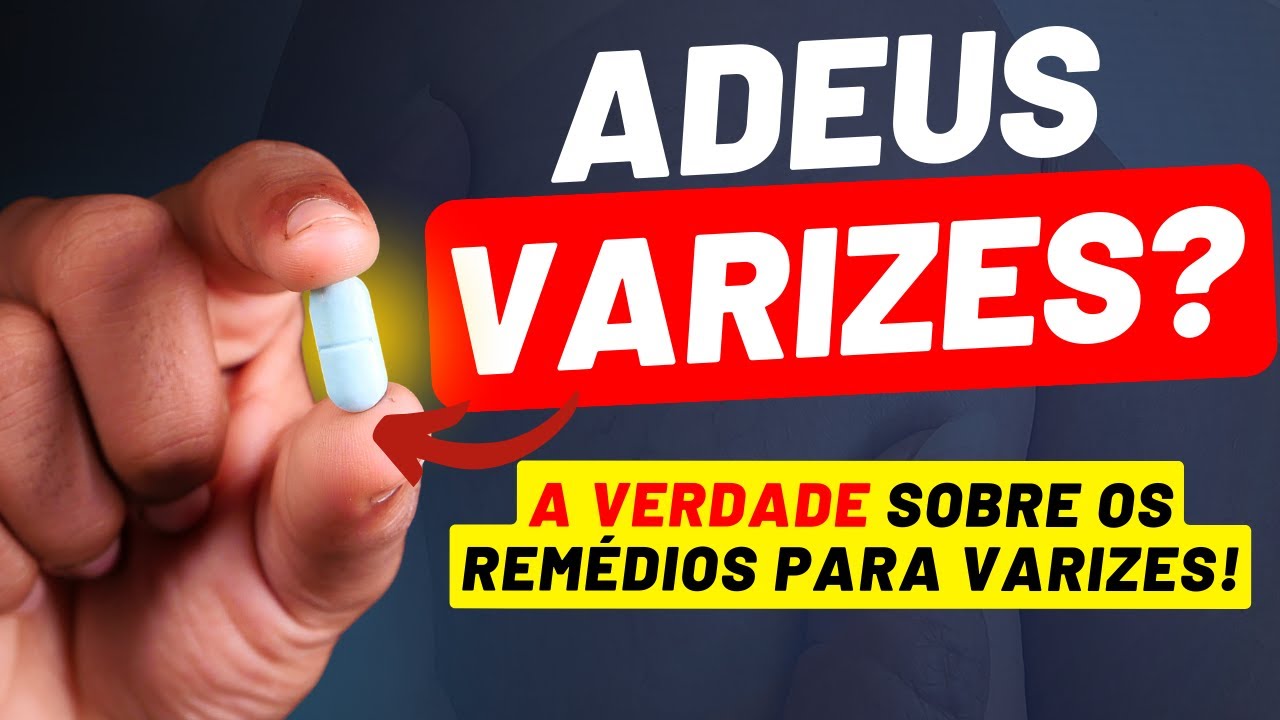 Remédio para VARIZES e DORES nas pernas - Existe remédio para eliminar as varizes ?