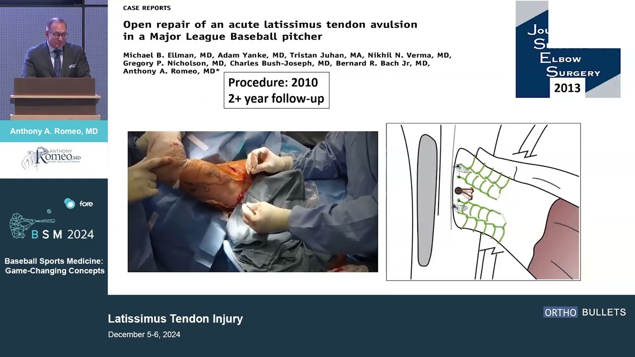Latissimus Tendon Injury_Dr  Anthony Romeo