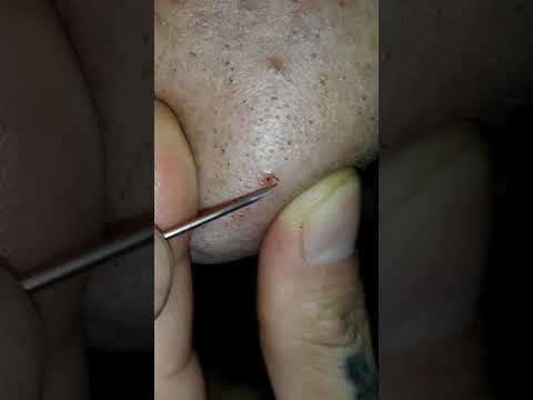 #trending 😱GIANT NEEDLE REMOVES #ingrownChinHair