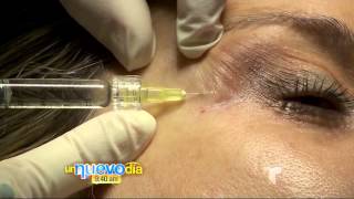 Tecnica Belotero | Un Nuevo Día | Telemundo