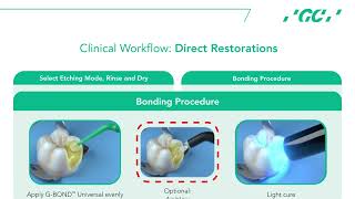 G-BOND™ Universal: Direct Restorations