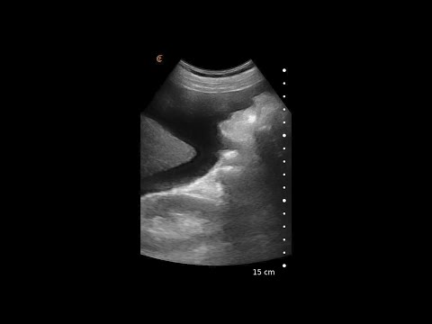 Aszites – Ultraschallbildinterpretation