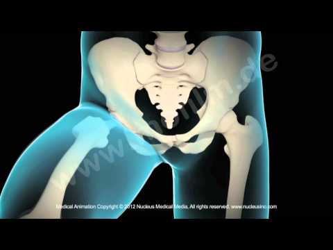 Neurom Wirbelsäule Halswirbelsäule HWS Arthritis und Osteochondrose