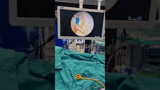 Technique of Trans Urethral Holmium laser enucleation of Prostate by Dr Aditya Sharma
