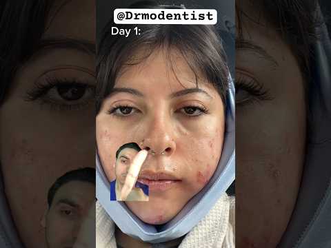 DIET For FAST Wisdom Teeth Removal Recovery #wisdomteethremovalrecovery #wisdomtoothremoval