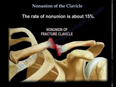 Nonunion Of The Clavicle - Everything You Need To Know - Dr. Nabil Ebraheim