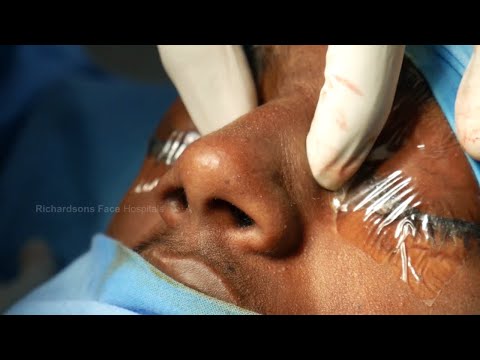 Fistula Closure Speech Surgery And Rhinoplasty