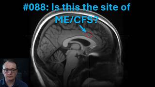 088 - Is this the site of ME/CFS