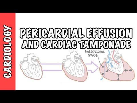 Cardiac Tamponade - pericardial effusion, causes, pathophysiology, investigations and treatment