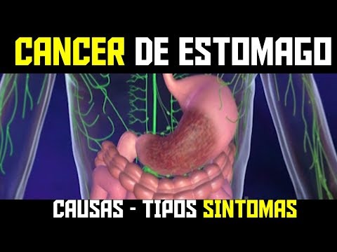 Cancer gastrico peritoneal