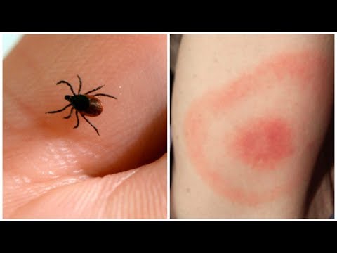 Staying safe during tick season: Our doctor answers questions about Lyme Disease