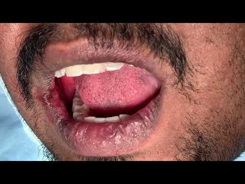 Planning Wisdom Tooth Removal Under Local Anesthesia